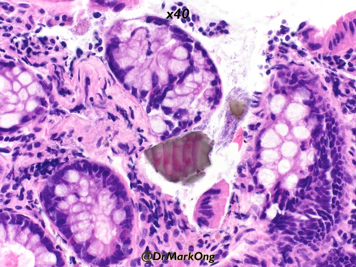 Colonic biopsies from an adult.

Diagnosis and likely clinical history?

P.S.: Didn't quite read the textbook

#GIpath #pathology #pathX