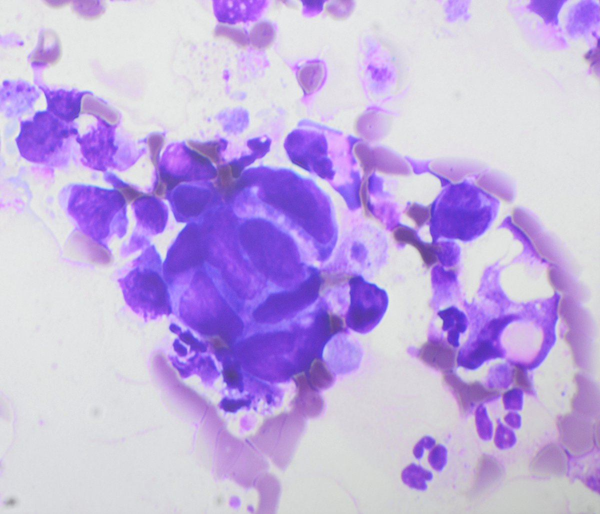 Pepe JimƩnez Heffernan (@pepeheffernan) on Twitter photo CC365. Bronchoalveolar lavage. Non-resolving pneumonia in a woman with a history of breast and colon carcinoma. No cell block, but liquid cytology specimen is available if needed. <a href="/kriyer68/">Kalyani Bambal</a> <a href="/DrBMcGinn/">Barry McGinn</a> <a href="/goziemnweke/">idlewild</a> CC365. Bronchoalveolar lavage. Non-resolving pneumonia in a woman with a history of breast and colon carcinoma. No cell block, but liquid cytology specimen is available if needed. <a href="/kriyer68/">Kalyani Bambal</a> <a href="/DrBMcGinn/">Barry McGinn</a> <a href="/goziemnweke/">idlewild</a>