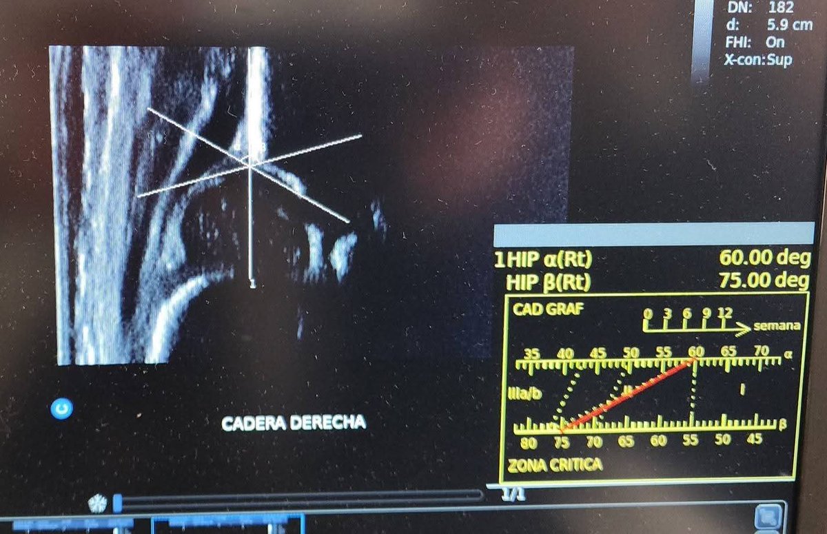 Traumapedia's tweet photo. Recuerda el mejor momento para realizar el tamiz de cadera es dentro del primer mes de vida. 
Es cuando se alcanzan los mejores resultados en un muy corto plazo usando el arnés de pavlik.
 #clinicadecaderapediatrica  #luxacioncongenitadecadera 
 #displasiadecadera
#arnesdepavlik https://t.co/w1CTUZNxLd