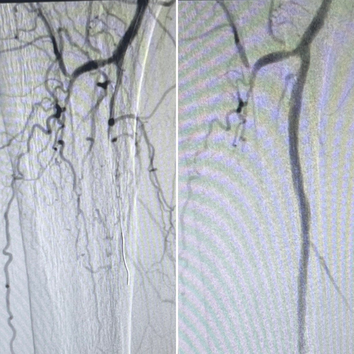 KJ Nagarsheth MD, MBA, FACS (@knagarshethmd) on Twitter photo Performed the first case using Javelin IVL in Maryland for a patient with CLTI and significant heart failure. Great angiographic result. #IVL <a href="/UMMC/">University of Maryland Medical Center</a> <a href="/MarylandSurg/">Department of Surgery, University of Maryland</a> <a href="/CLI_Global/">CLI Global Society</a> <a href="/VascularSVS/">Vascular SVS</a> <a href="/FadiSaab17/">Fadi Saab</a> <a href="/dandu_n/">Zola N'Dandu, MD</a> <a href="/mattsmeds/">Matthew Smeds</a> <a href="/farkomd/">frank arko</a> <a href="/NickMouawadMD/">Nick Mouawad</a> <a href="/kmadass/">Kumar Madassery</a> <a href="/AmputationSuck/">👊🏾👍🏾BT Fisher Sr., MD</a> Performed the first case using Javelin IVL in Maryland for a patient with CLTI and significant heart failure. Great angiographic result. #IVL <a href="/UMMC/">University of Maryland Medical Center</a> <a href="/MarylandSurg/">Department of Surgery, University of Maryland</a> <a href="/CLI_Global/">CLI Global Society</a> <a href="/VascularSVS/">Vascular SVS</a> <a href="/FadiSaab17/">Fadi Saab</a> <a href="/dandu_n/">Zola N'Dandu, MD</a> <a href="/mattsmeds/">Matthew Smeds</a> <a href="/farkomd/">frank arko</a> <a href="/NickMouawadMD/">Nick Mouawad</a> <a href="/kmadass/">Kumar Madassery</a> <a href="/AmputationSuck/">👊🏾👍🏾BT Fisher Sr., MD</a>