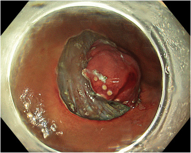 VideoGIE Editor's Choice: "Challenges and solutions in endoscopic full-thickness resection" by Fatih Aslan et al. Watch it here: hubs.ly/Q03pHFHL0 #GITwitter #VideoGIE #VideoGIEJournal