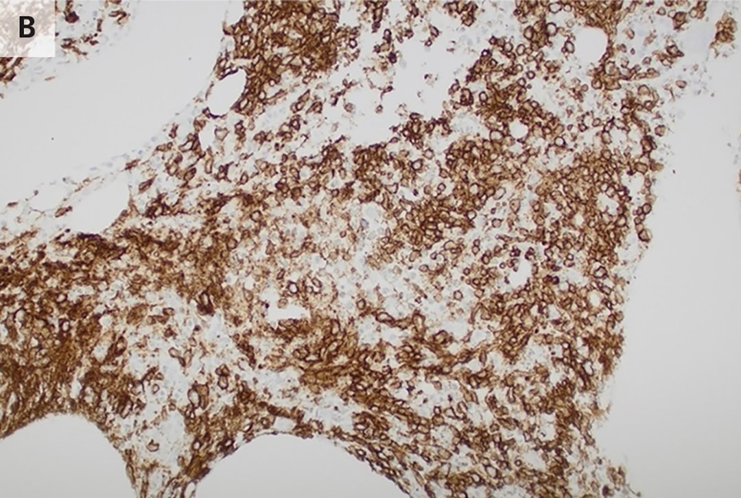 NEJM Evidence (@nejmevidence) on Twitter photo A 47-year-old woman has had fevers and malaise for 6 weeks, and pain in the left shoulder for the past two weeks. What is the differential diagnosis? Read the Morning Report: eviden.cc/44I2JpY
<a href="/ClementLeeMD/">Clement Lee, MD, MSc</a> <a href="/justincheungmd/">Justin Cheung, MD</a> #MedTwitter A 47-year-old woman has had fevers and malaise for 6 weeks, and pain in the left shoulder for the past two weeks. What is the differential diagnosis? Read the Morning Report: eviden.cc/44I2JpY
<a href="/ClementLeeMD/">Clement Lee, MD, MSc</a> <a href="/justincheungmd/">Justin Cheung, MD</a> #MedTwitter