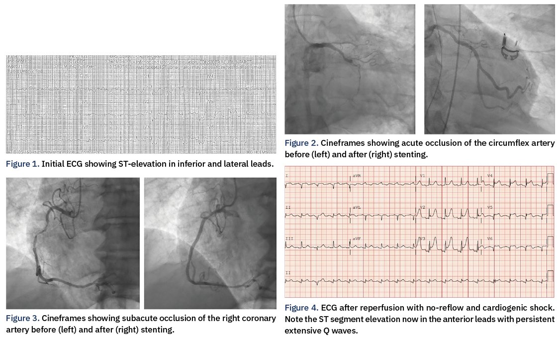 CathLabDigest's tweet image. Conversations in Cardiology: The Late-Arriving STEMI Pt
"Everything seems perfectly routine. The patient is brought to the cath lab, the infarct-related artery is identified, wired, and ballooned — from there, the patient decompensates."
hubs.ly/Q03sqz1g0
#cardiotwitter