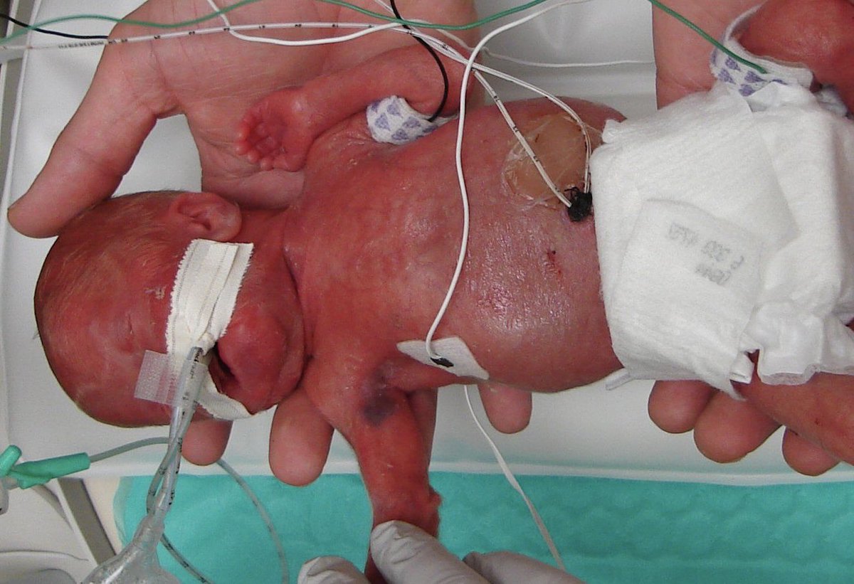 You can now abort this life/human being/foetus/cell cluster (delete as applicable) at 24 weeks, no questions asked 😬

Image at actual 24 weeks ……