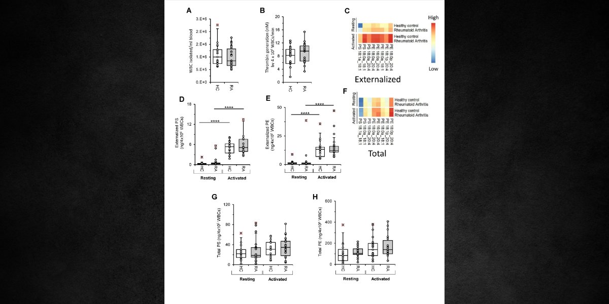 JLR press| Costa et al.'s data suggest that elevated plasma extracellular vesicle levels in rheumatoid arthritis are a major source of pro-coagulant membranes.
Learn more:
jlr.org/article/S0022-…