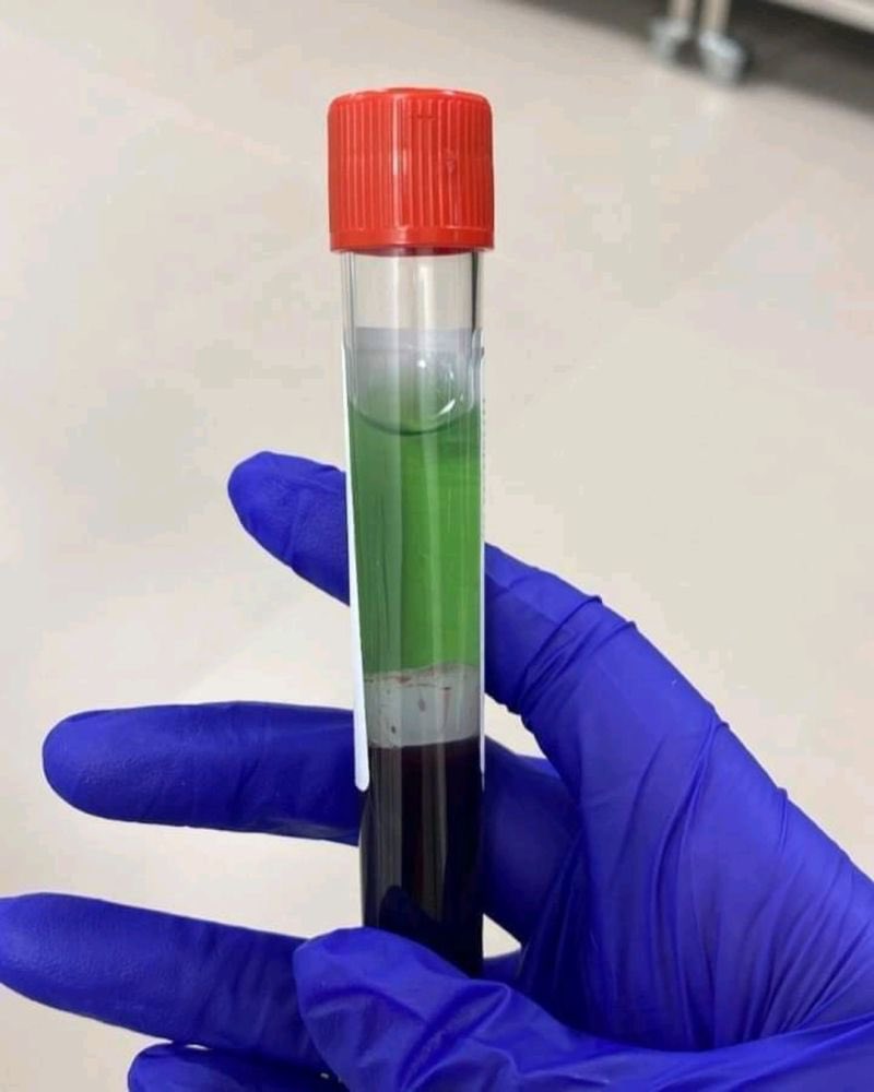 Unusual blood sample from a patient. What’s the diagnosis?