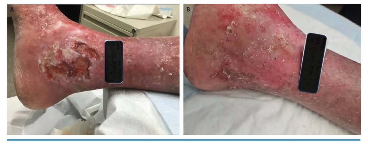 Chronic Wound Care of the Lower Extremities: What Every Vascular Specialist Needs to Know. This review discusses how to evaluate the underlying causes of chronic wounds, how to characterize a wound during initial workup, and holistic treatment. 
hubs.ly/Q03sjMBC0 <a href="/kmadass/">Kumar Madassery</a>