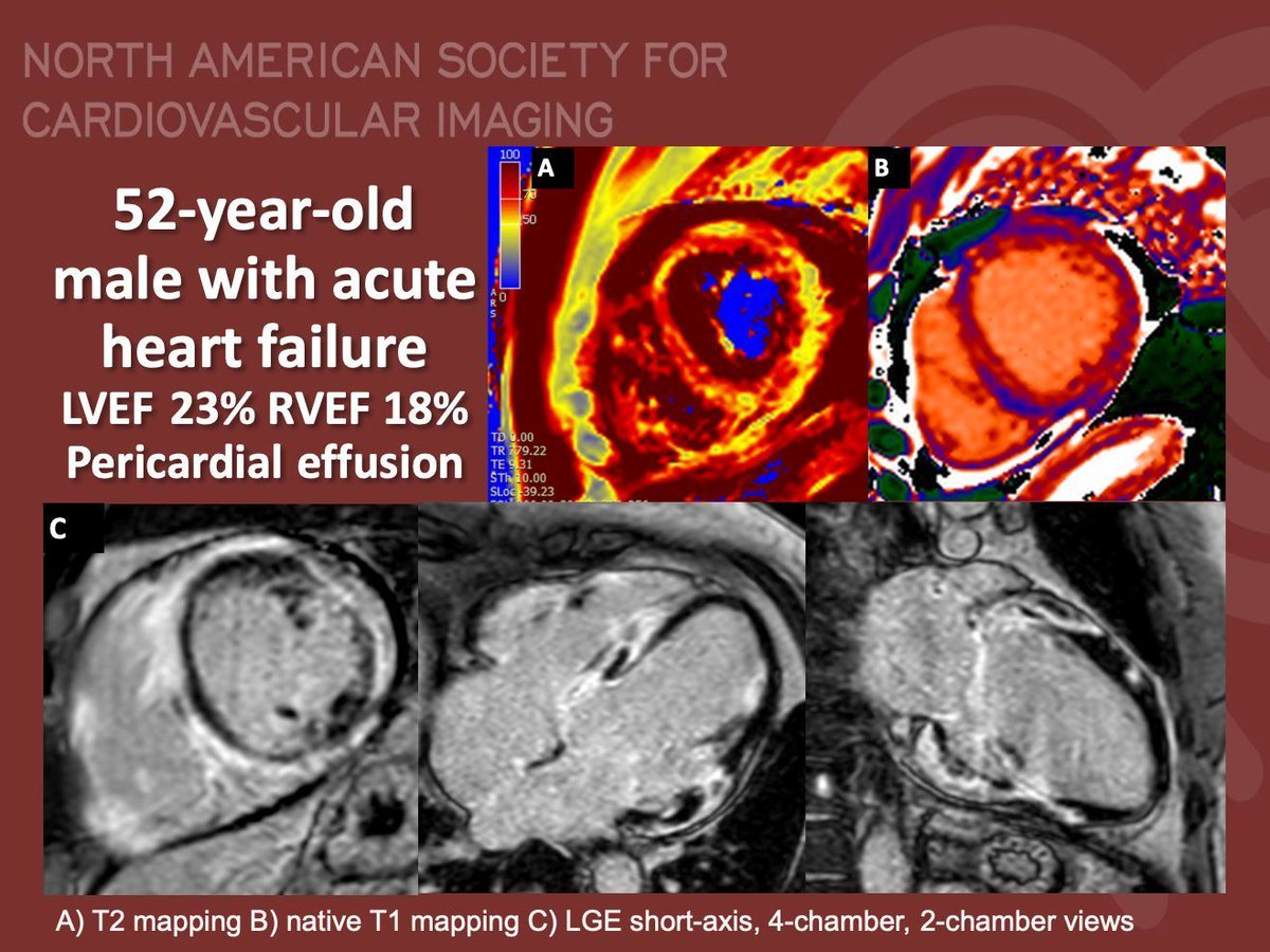 NASCISociety's tweet image. #NASCI Case Series
Case 82
Courtesy of @CarlottaOnnis @MichelePorcu87 @lucasabaITA from University of Cagliari @univca
What is the right answer?
#whyCMR #YesCCT
@GregKicska @JRevRad1 @dianalitmano @DanielVargasMD @kirschj @prachipagarwal @AwsHamid5 @EscrOffice @DeCeccoCN