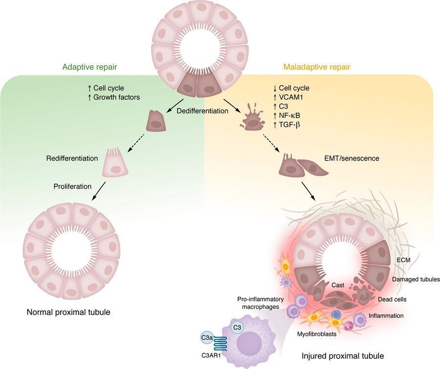 Elevations in local complement are linked with kidney fibrosis that progressively impairs renal function. 
Portilla et al. highlight the potential for complement-targeted therapeutics to slow fibrosis progression in CKD and other kidney diseases. jci.org/articles/view/…