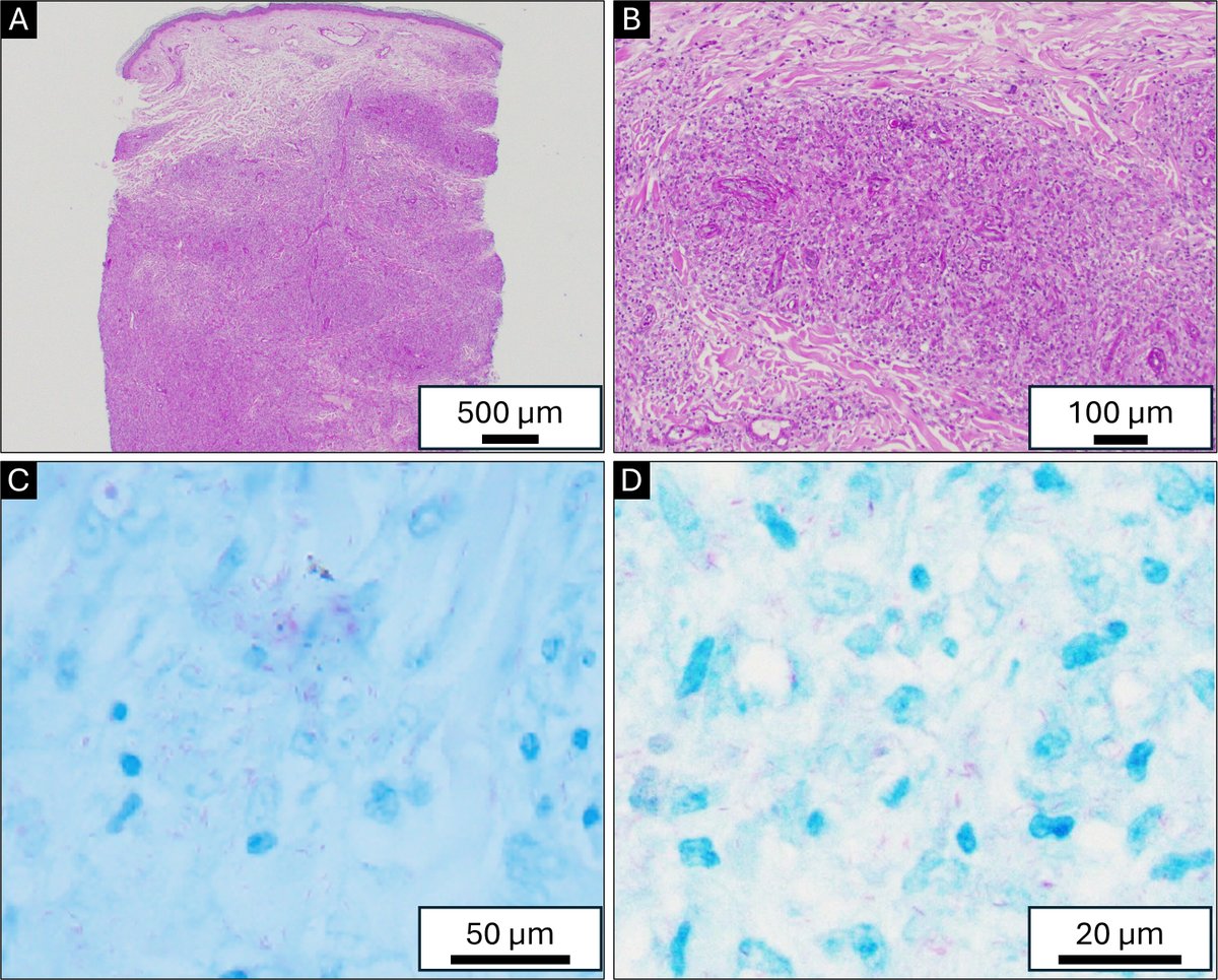 ASMCaseReports (@asmcasereports) on Twitter photo New from <a href="/ASMCaseReports/">ASMCaseReports</a>: Hansen’s disease patient in Ohio successfully treated with a monthly rifampin, minocycline, and moxifloxacin regimen | <a href="/CWRUSOM/">CWRU School of Medicine</a> #ASMCaseReports <a href="/ASMicrobiology/">ASM</a>
Free to read: doi.org/10.1128/asmcr.… New from <a href="/ASMCaseReports/">ASMCaseReports</a>: Hansen’s disease patient in Ohio successfully treated with a monthly rifampin, minocycline, and moxifloxacin regimen | <a href="/CWRUSOM/">CWRU School of Medicine</a> #ASMCaseReports <a href="/ASMicrobiology/">ASM</a>
Free to read: doi.org/10.1128/asmcr.…