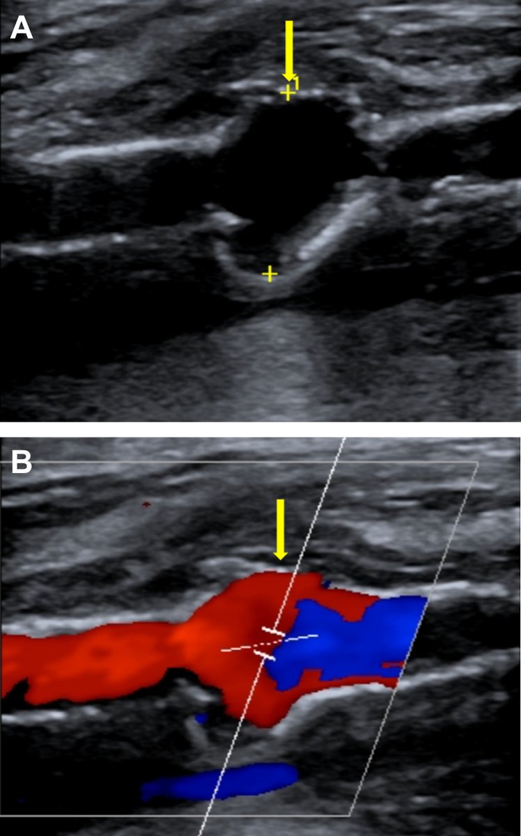 ASMCaseReports (@asmcasereports) on Twitter photo Haemophilus influenzae-associated mycotic aneurysm months after treated bacteremia | <a href="/EmoryUniversity/">Emory University</a> #ASMCaseReports
Free to read: journals.asm.org/doi/10.1128/as… Haemophilus influenzae-associated mycotic aneurysm months after treated bacteremia | <a href="/EmoryUniversity/">Emory University</a> #ASMCaseReports
Free to read: journals.asm.org/doi/10.1128/as…
