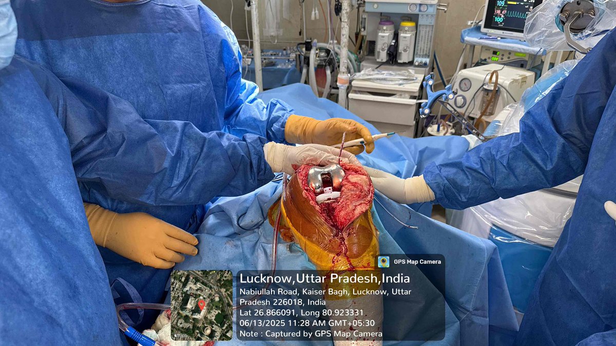 KING GEORGE MEDICAL UNIVERSITY, LUCKNOW, UP, INDIA (@kgmu_medical) on Twitter photo 🤖 First-ever Robotic Knee Replacement Surgeries at KGMU!
A historic milestone as three Ayushman Bharat beneficiaries successfully underwent robotic total knee arthroplasty under the expert team led by Dr. Ashish Kumar. <a href="/aiims_newdelhi/">AIIMS, New Delhi 🇮🇳</a> <a href="/AIIMSBhopal/">AIIMS-Bhopal Official</a> <a href="/SGPGI/">SGPGI</a> @NMC_INDIA <a href="/IITKanpur/">IIT Kanpur</a> 🤖 First-ever Robotic Knee Replacement Surgeries at KGMU!
A historic milestone as three Ayushman Bharat beneficiaries successfully underwent robotic total knee arthroplasty under the expert team led by Dr. Ashish Kumar. <a href="/aiims_newdelhi/">AIIMS, New Delhi 🇮🇳</a> <a href="/AIIMSBhopal/">AIIMS-Bhopal Official</a> <a href="/SGPGI/">SGPGI</a> @NMC_INDIA <a href="/IITKanpur/">IIT Kanpur</a>