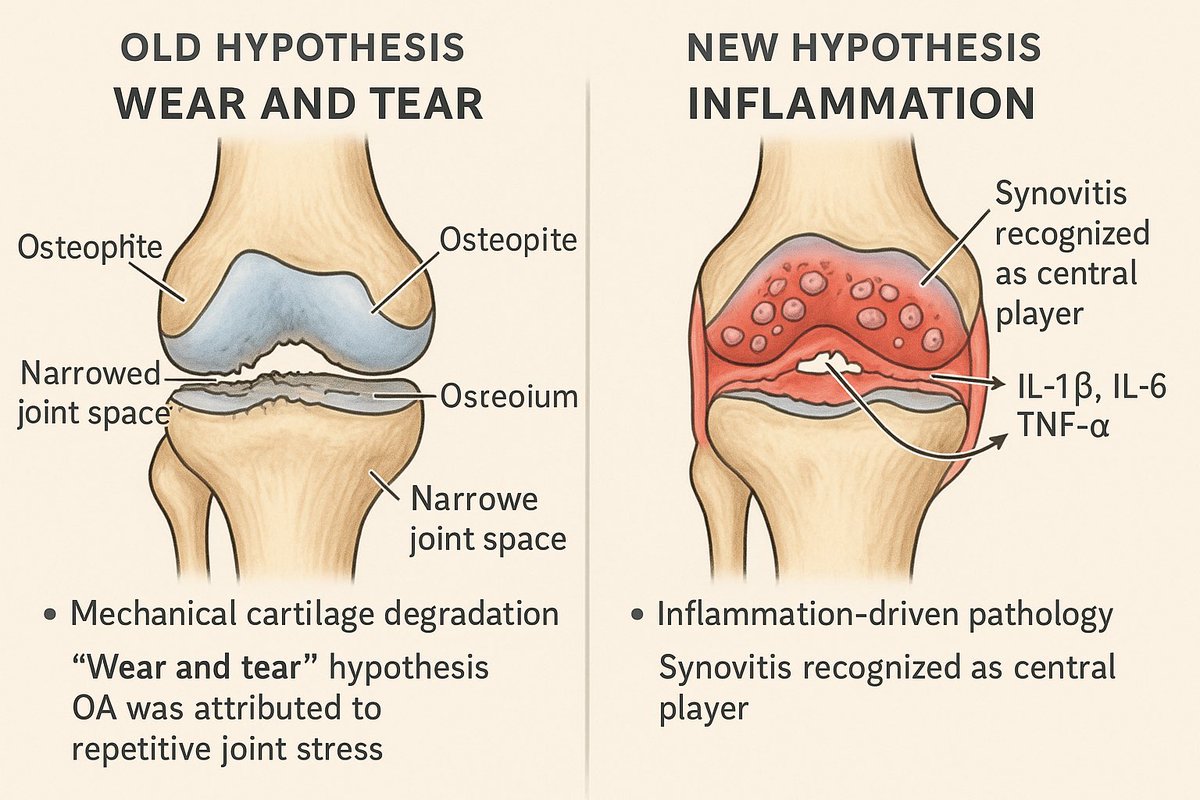 KoneruMd's tweet image. 💥New Paradigm for the pathophysiology of Osteoarthritis (OA)
The understanding of OA pathophysiology has undergone a paradigm shift, moving from a mechanical “wear and tear” model to one emphasizing synovial inflammation and immune-mediated joint degeneration.
Here’s how…