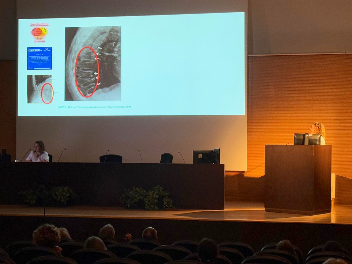 Reumatologia HUGTiP (@reumatologiahgt) on Twitter photo <a href="/laiagifre1/">Laia Gifre</a> <a href="/cristicarbo/">cristina carbonell</a> <a href="/seiomm/">SEIOMM</a> <a href="/primariaicscat/">Atenció Primària i a la Comunitat de l'ICS</a> <a href="/DrMartinezL/">Daniel Martínez</a> <a href="/FoundationIof/">International Osteoporosis Foundation IOF</a> <a href="/SCReuma/">Societat Catalana de Reumatologia</a> A continuación la Dra Massó del <a href="/nfrgermanstrias/">Nefrología Germans Trias</a> ha presentado una actualización de #osteoporosis en la ERC:
▶️cambios en PTH, FGF23, Klotho en la ERC
▶️complejo CKD-MBD (relación ERC, riesgo CV y OP)
▶️identificación del hueso adinámico
▶️recomendaciones de abordaje y tto antiOP <a href="/laiagifre1/">Laia Gifre</a> <a href="/cristicarbo/">cristina carbonell</a> <a href="/seiomm/">SEIOMM</a> <a href="/primariaicscat/">Atenció Primària i a la Comunitat de l'ICS</a> <a href="/DrMartinezL/">Daniel Martínez</a> <a href="/FoundationIof/">International Osteoporosis Foundation IOF</a> <a href="/SCReuma/">Societat Catalana de Reumatologia</a> A continuación la Dra Massó del <a href="/nfrgermanstrias/">Nefrología Germans Trias</a> ha presentado una actualización de #osteoporosis en la ERC:
▶️cambios en PTH, FGF23, Klotho en la ERC
▶️complejo CKD-MBD (relación ERC, riesgo CV y OP)
▶️identificación del hueso adinámico
▶️recomendaciones de abordaje y tto antiOP