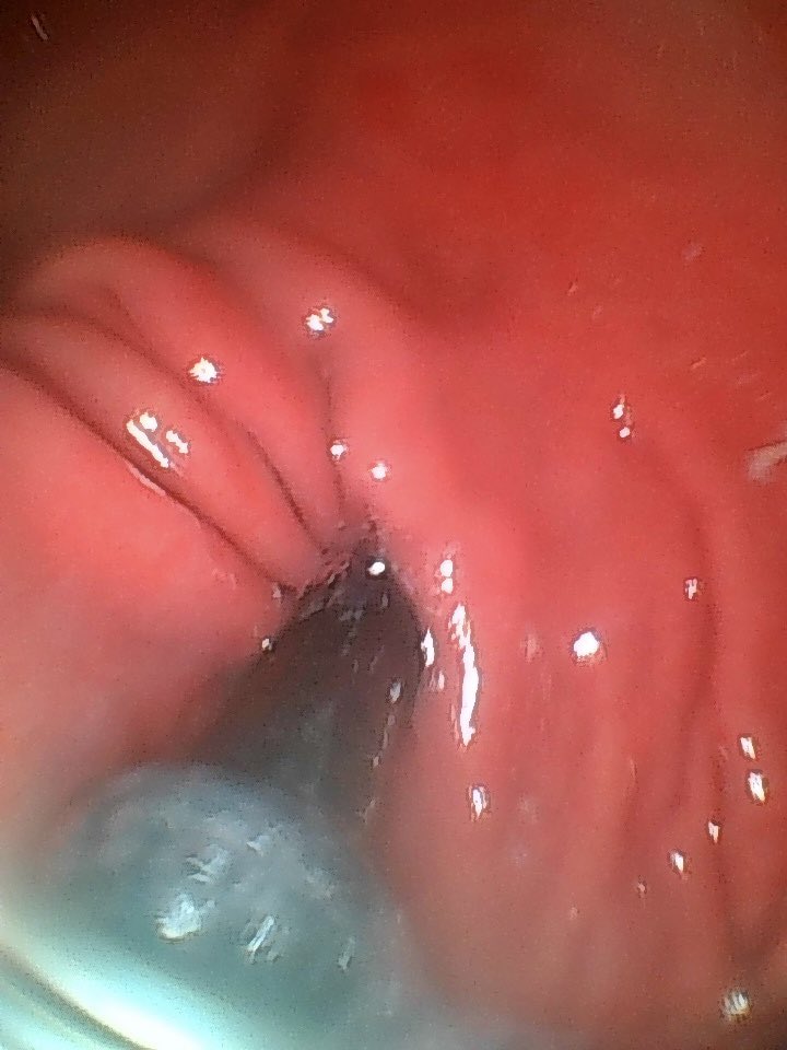My camera crew couldn’t find any sign of the party last night, but they did grab this shot of the cardiac sphincter 😳 The same one that’ll squeeze you tightly as it spits you unceremoniously into my gut 

#vore #pov #endoscope #sizetwitter #shrunken