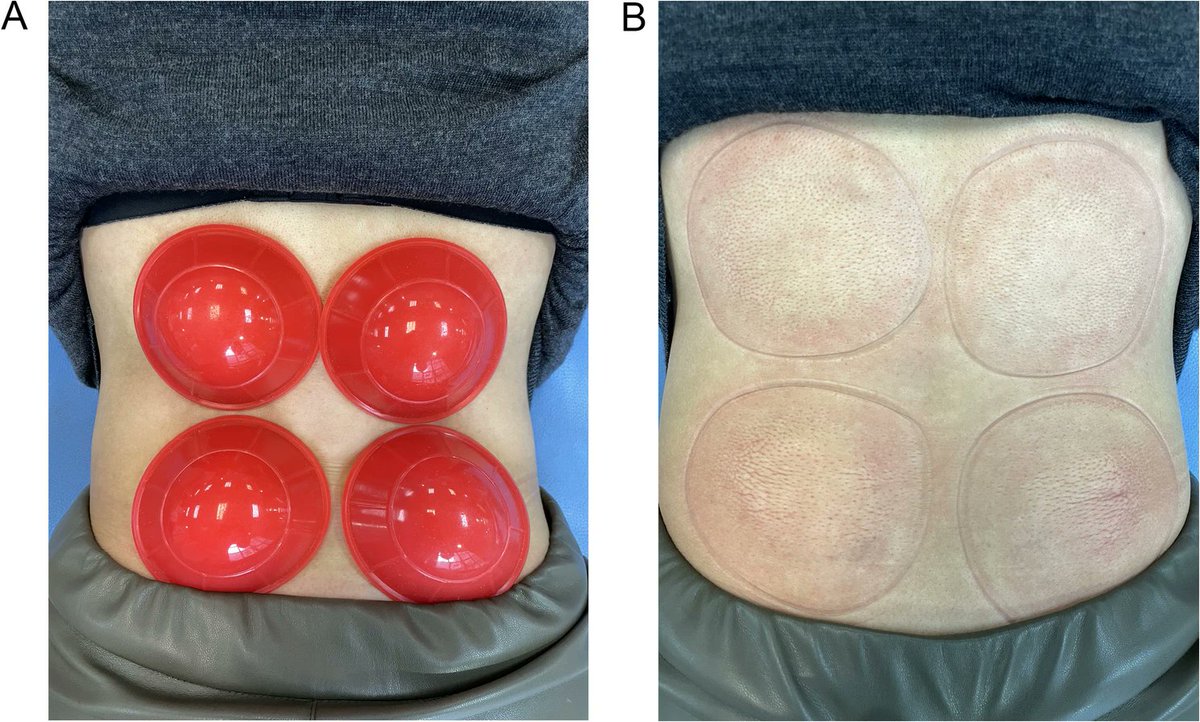 Surprising results....😅

Dry  cupping therapy combined with conventional therapy does not provide  additional benefits over conventional therapy alone in patients with  non-specific chronic low back pain: a randomized trial

chiromt.biomedcentral.com/articles/10.11…
