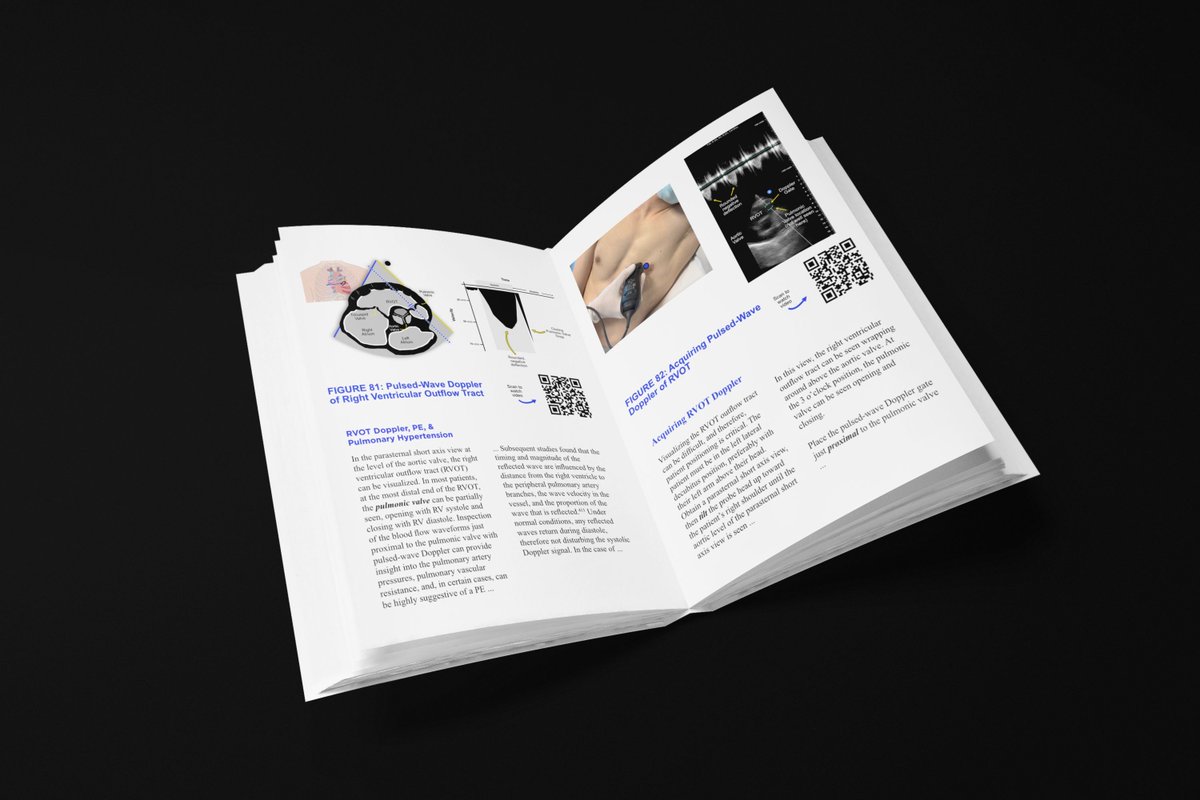 Author of the @pocus_manifesto @Dr_larryi has a new #POCUS book coming out! The POCUS Textbook will be available this summer in Hardcover and Kindle. It focuses on crystal-clear figures without confusing abbreviations, and associated QR code videos, accessible for free with any