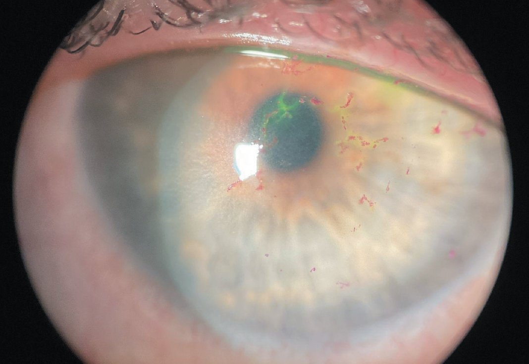 Maneuvering the Maze: Exploring Tough Cornea Cases

Having the right tools in your practice will help solve some of the most complex issues: reviewofcontactlenses.com/article/maneuv…
#cornea #optometry