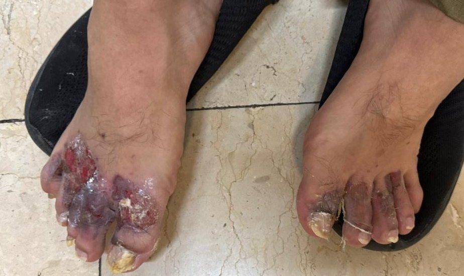 Llegó un paciente de 29 años tras presentar dolor por ponerse vinagre con ajo en los pies, como "tratamiento para hongos" con quemaduras de 2° grado. La ignorancia sale cara, NO SE AUTOMEDIQUEN.