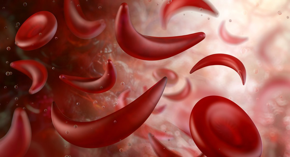 Sickle cell disease is a group of inherited blood cell disorders that affect hemoglobin, the protein that carries oxygen through the body. Here is the cause of sickle cell disease, its symptoms, and how it is diagnosed and managed. 
jamaicahospital.org/newsletter/sic…
#SickleCellDisease