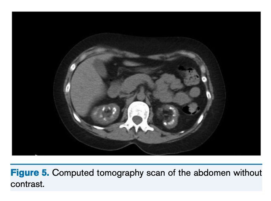In this Core Curriculum, <a href="/RWBonner91/">Ryan Bonner</a> and Gerald Hladik describe the etiologies and pathophysiologic disturbances leading to renal tubular acidoses:

bit.ly/3EIS8jl  (FREE)

<a href="/UNCKidney/">UNC Kidney Center</a>