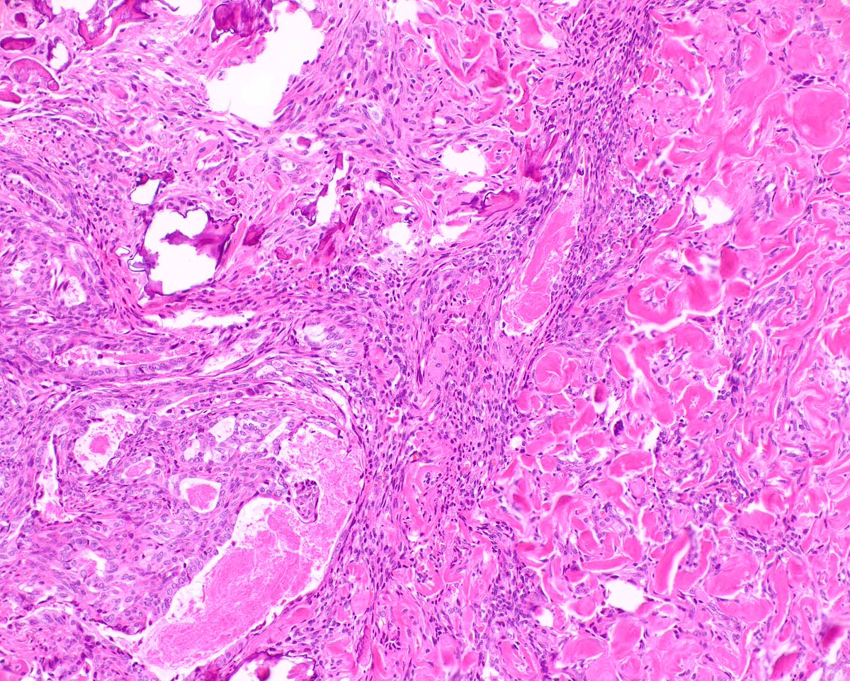 ModernPathology's tweet image. Synovial sarcoma can pop up anywhere - including the GI tract.  This example  is perfectly biphasic and has calcification at no extra charge.
Ortiz Requena D, Longacre TA, Rosenberg AE, Velez Torres JM, Yanchenko N, Garcia-Buitrago MT, Voltaggio L, Montgomery EA. Synovial Sarcoma…