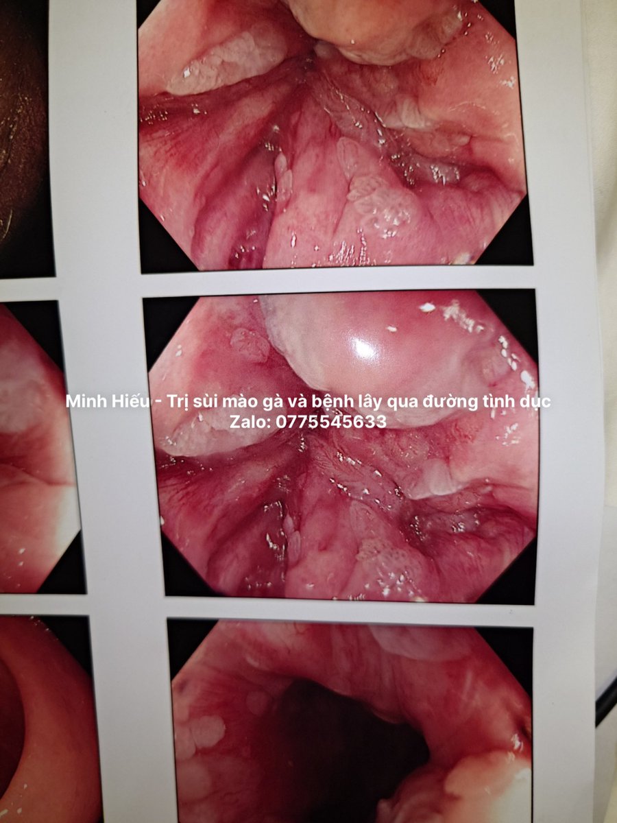 Hình ảnh nội soi sùi trong hậu môn của một bạn  nam sinh viên... thương thật sự
Liên hệ zalo để dc hỗ trợ: 0775545633 hoặc 0866405922