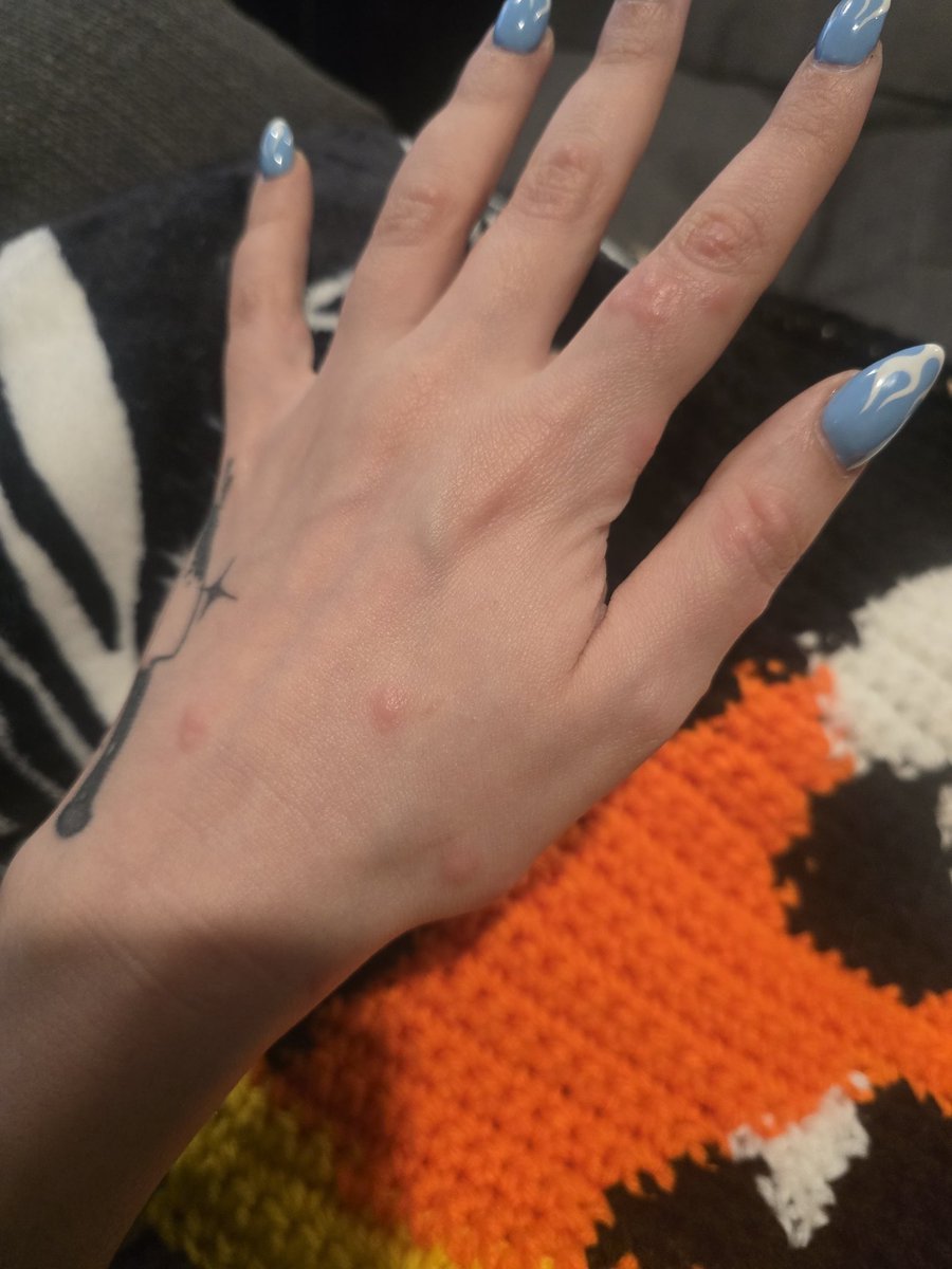 THEYRE NOT HIVES. who forgot to tell me to sleep tight and dont let the bed bugs bite???