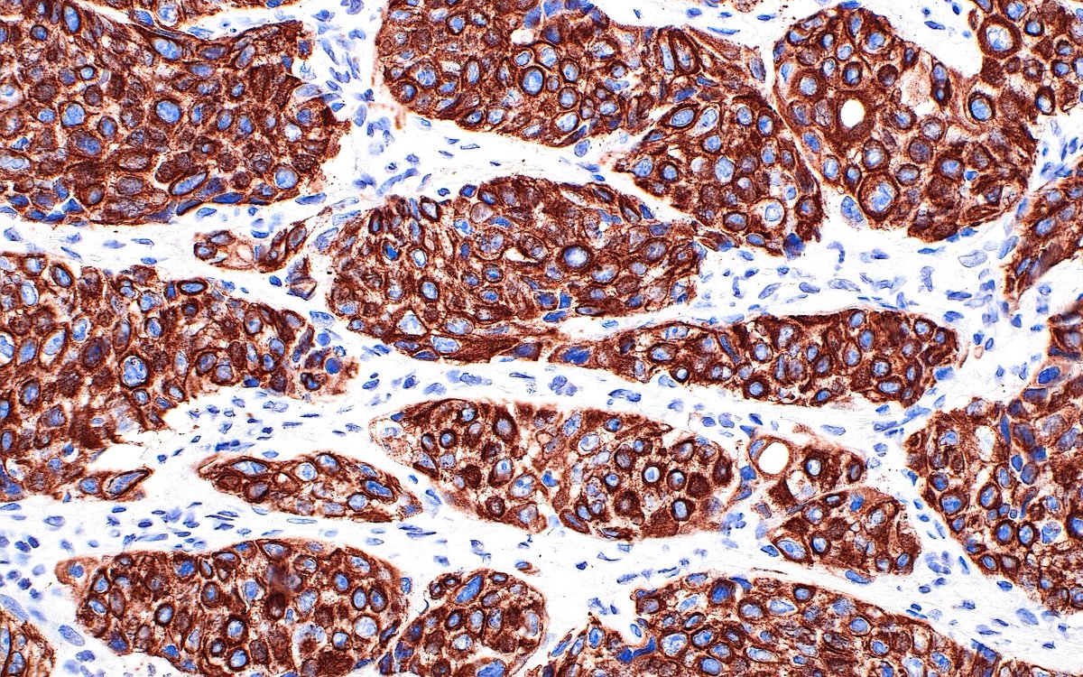 ziad_zaatari's tweet image. 🔬 Invasive Urothelial Carcinoma, High Molecular Weight Cytokeratin Immunostain ~ #Pathology #IHCpath #GUpath #Histology #PathArt