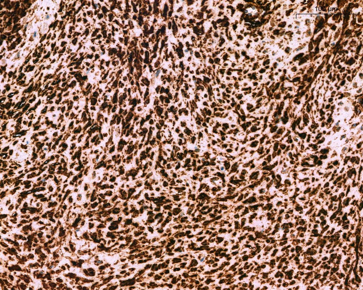 A. Polónia (@poloniaantonio) on Twitter photo The answer would be beta-catenin. Kudos to <a href="/Histopatolomon/">Pascual Meseguer</a> 👏 as mentioned by many, one should always start with CKs😃#breastpath <a href="/atman_ci/">Dr. Luca</a> <a href="/DrGeeONE/">Olaleke Folaranmi</a> <a href="/fouad_boulos/">Fouad Boulos</a> <a href="/RazaHoda/">Raza Hoda MD</a> <a href="/ADamronMD/">Alexander Damron, MD</a> <a href="/Teclis82/">Brian McMillen MD</a> <a href="/LizaMQuintana/">Liza Quintana, MD</a> <a href="/tlabiano/">Tania Labiano</a> <a href="/A_Morini_MD/">Aurélien Morini, MD, MSc 🇫🇷🇪🇺💙💛</a> <a href="/ariella8/">Celina Stayerman MD</a> <a href="/surgpathlahore/">Nusrat Z. Bokhari</a> <a href="/amalasar86/">Amal Asar, FRCPath, MAcadMED</a> The answer would be beta-catenin. Kudos to <a href="/Histopatolomon/">Pascual Meseguer</a> 👏 as mentioned by many, one should always start with CKs😃#breastpath <a href="/atman_ci/">Dr. Luca</a> <a href="/DrGeeONE/">Olaleke Folaranmi</a> <a href="/fouad_boulos/">Fouad Boulos</a> <a href="/RazaHoda/">Raza Hoda MD</a> <a href="/ADamronMD/">Alexander Damron, MD</a> <a href="/Teclis82/">Brian McMillen MD</a> <a href="/LizaMQuintana/">Liza Quintana, MD</a> <a href="/tlabiano/">Tania Labiano</a> <a href="/A_Morini_MD/">Aurélien Morini, MD, MSc 🇫🇷🇪🇺💙💛</a> <a href="/ariella8/">Celina Stayerman MD</a> <a href="/surgpathlahore/">Nusrat Z. Bokhari</a> <a href="/amalasar86/">Amal Asar, FRCPath, MAcadMED</a>
