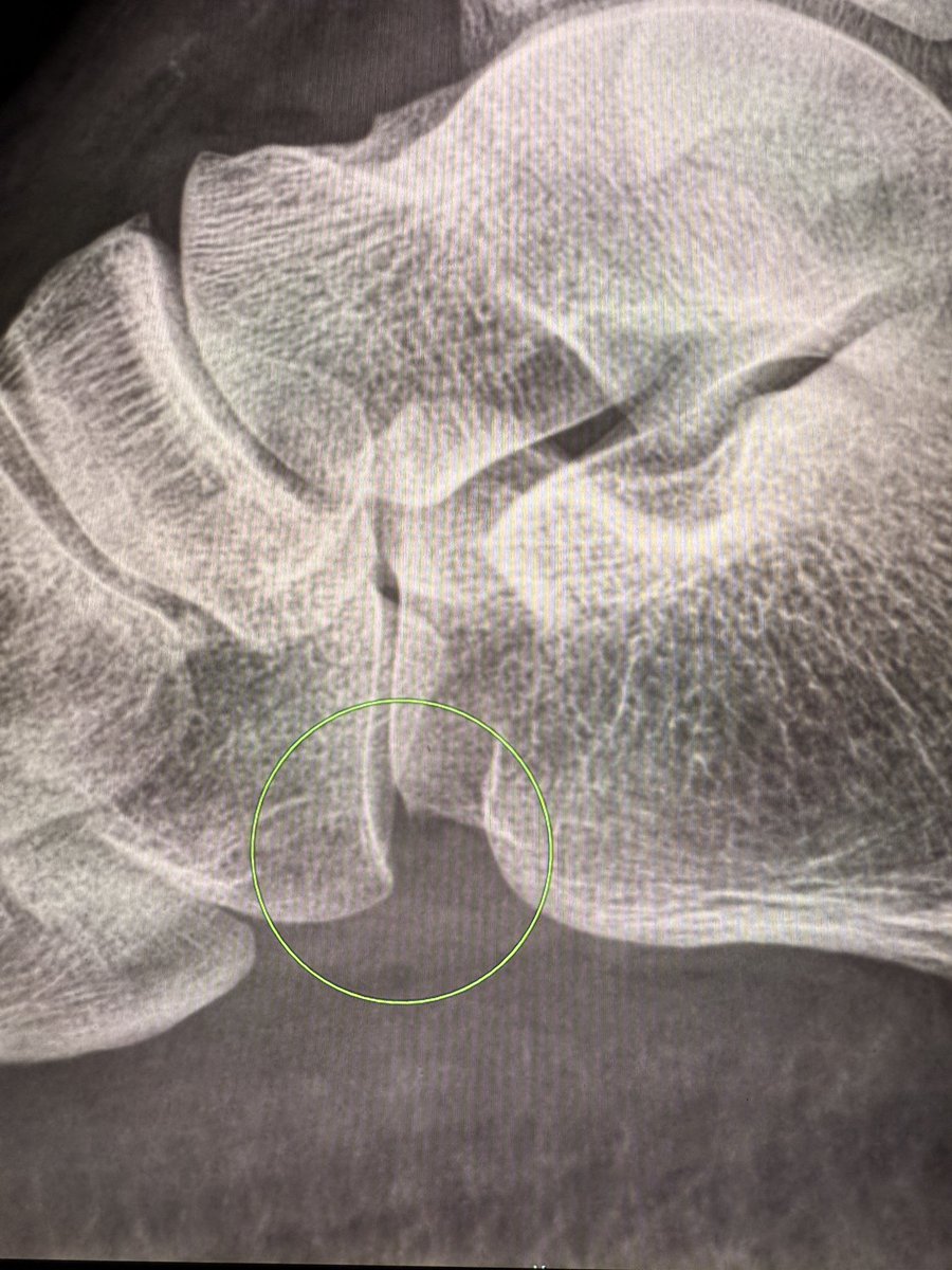 On lateral ankle radiographs, the cuboid often appears inferior to the calcaneum at the calcaneocuboid joint—up to one-fourth of the articular surface.

It’s normal. Not every step-down is subluxation.

—Pearls and pitfalls from my reporting list
