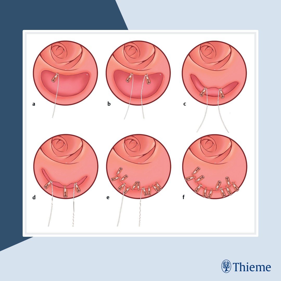 #EVideo: Cotton thread–clip combo enables closure of large post-ESD defects

Find the full text and video here: doi.org/10.1055/a-2535…

Jia Xu, Weixing Yang et al.