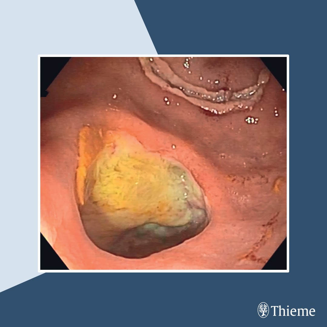 #EVideo: Tack-and-suture system repairs large rectal perforation

Find the full text and video here: doi.org/10.1055/a-2515…

Lidia Marti Romero et al.