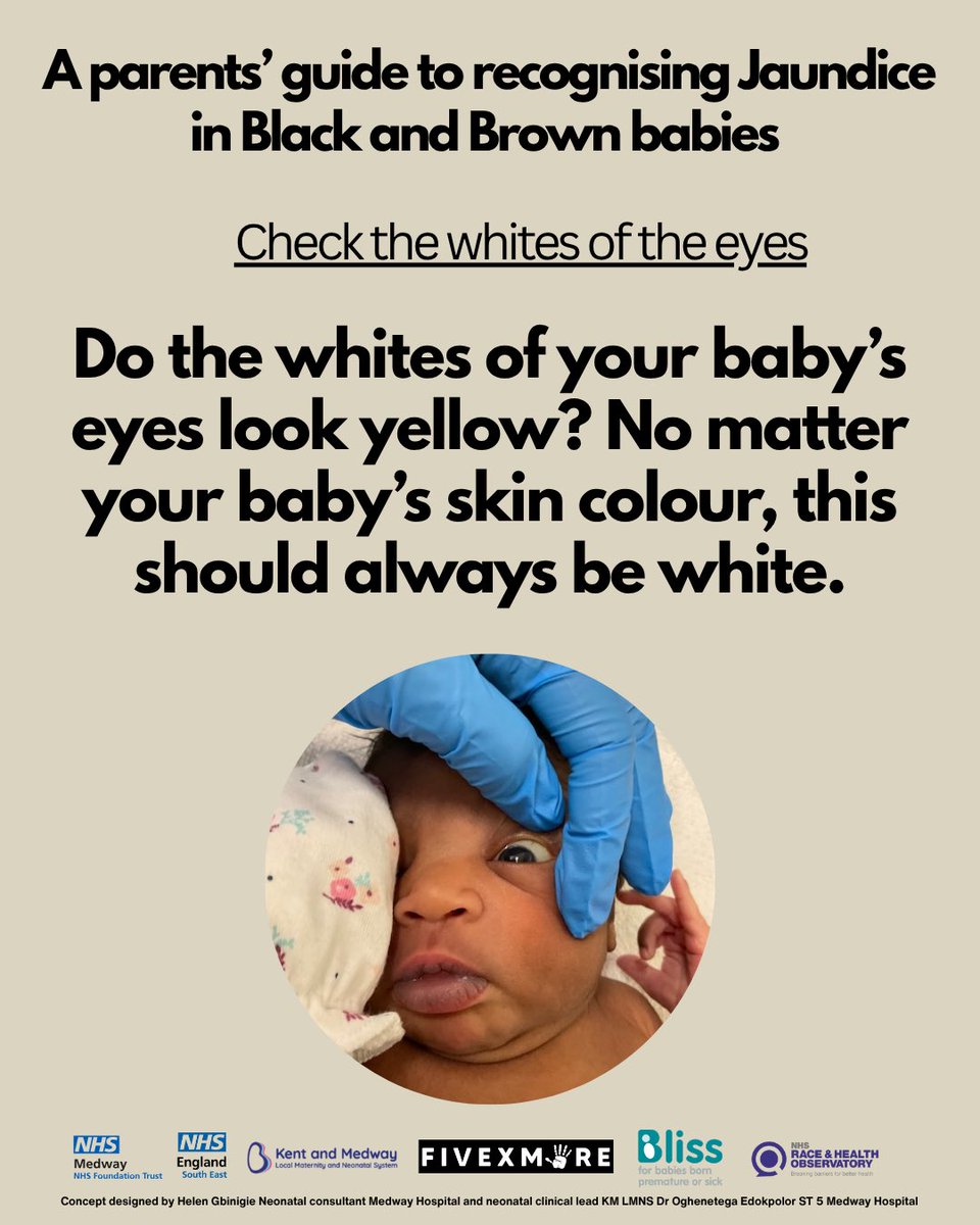 Do you know how to spot Jaundice on Black babies?

We’ve been working behind the scenes on a new resource designed to support and empower Black and Brown parents and it’s finally here.

In collaboration with Bliss, NHS Medway, Kent and Medway Neonatal Network, NHS England South