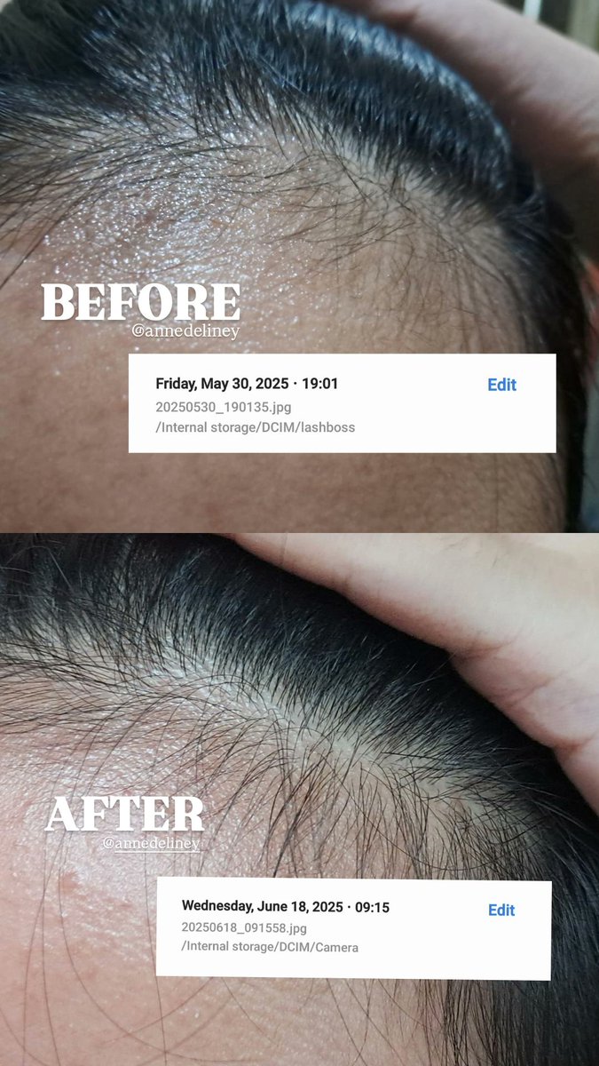 AKHIRNYA... tumbuh baby hair di sela-sela kepitakan rmbut ku

btw ini first time ak pake rosemary oil as haircare routine ternyata manjurr juga ya 😌🤌🏻