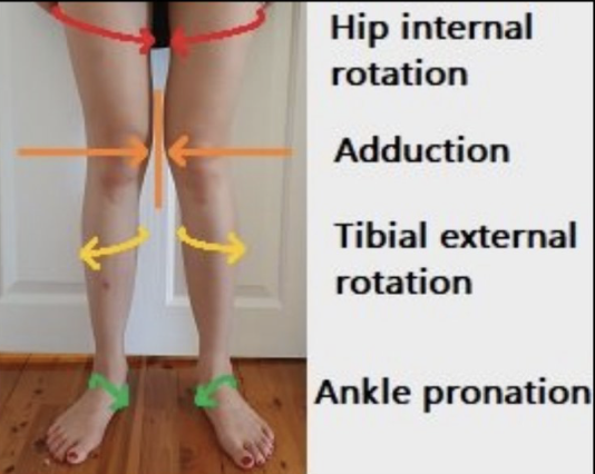 Barefoot_Will_'s tweet photo. Over-pronators are prone to suffering from PTTD
(Posterior Tibial Tendon Dysfunction)

1. Ankle Pronation
2. Collapse of the Arch
3. Lack of Big Toe Control
4. Excessive Tibial External Rotation
5. Uncontrolled Hip Internal Rotation

All common biomechanical deficiencies I see within people who tend to over-pronate

A main contributor to these patterns is due to a weakness within the Posterior Tibialis

The Posterior Tibialis is one of the primary 'supporting' muscles of the arch of the foot

Strengthening the Posterior Tib is a critical for recovery from PTTD (example exercise in post below)

But like I said, PTTD isn't just a Posterior Tibialis issue.. 

Over-Pronation creates a kinetic chain disaster & it's vitally important to the address the issue through a collective "From the Ground Up" approach