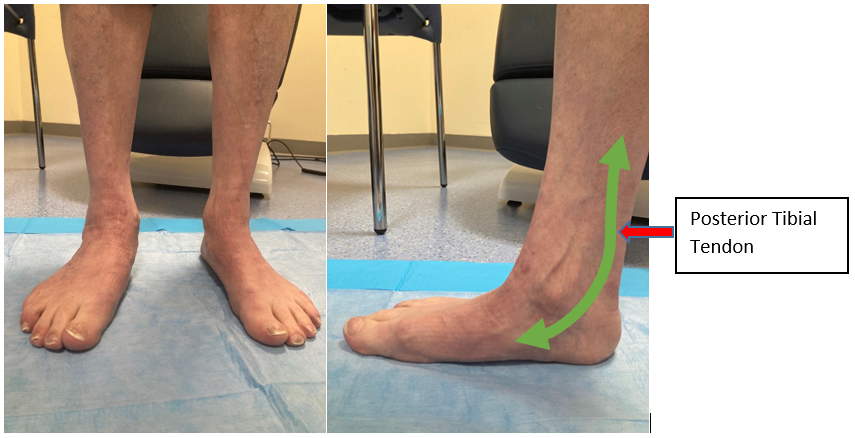 Barefoot_Will_'s tweet photo. Over-pronators are prone to suffering from PTTD
(Posterior Tibial Tendon Dysfunction)

1. Ankle Pronation
2. Collapse of the Arch
3. Lack of Big Toe Control
4. Excessive Tibial External Rotation
5. Uncontrolled Hip Internal Rotation

All common biomechanical deficiencies I see within people who tend to over-pronate

A main contributor to these patterns is due to a weakness within the Posterior Tibialis

The Posterior Tibialis is one of the primary 'supporting' muscles of the arch of the foot

Strengthening the Posterior Tib is a critical for recovery from PTTD (example exercise in post below)

But like I said, PTTD isn't just a Posterior Tibialis issue.. 

Over-Pronation creates a kinetic chain disaster & it's vitally important to the address the issue through a collective "From the Ground Up" approach