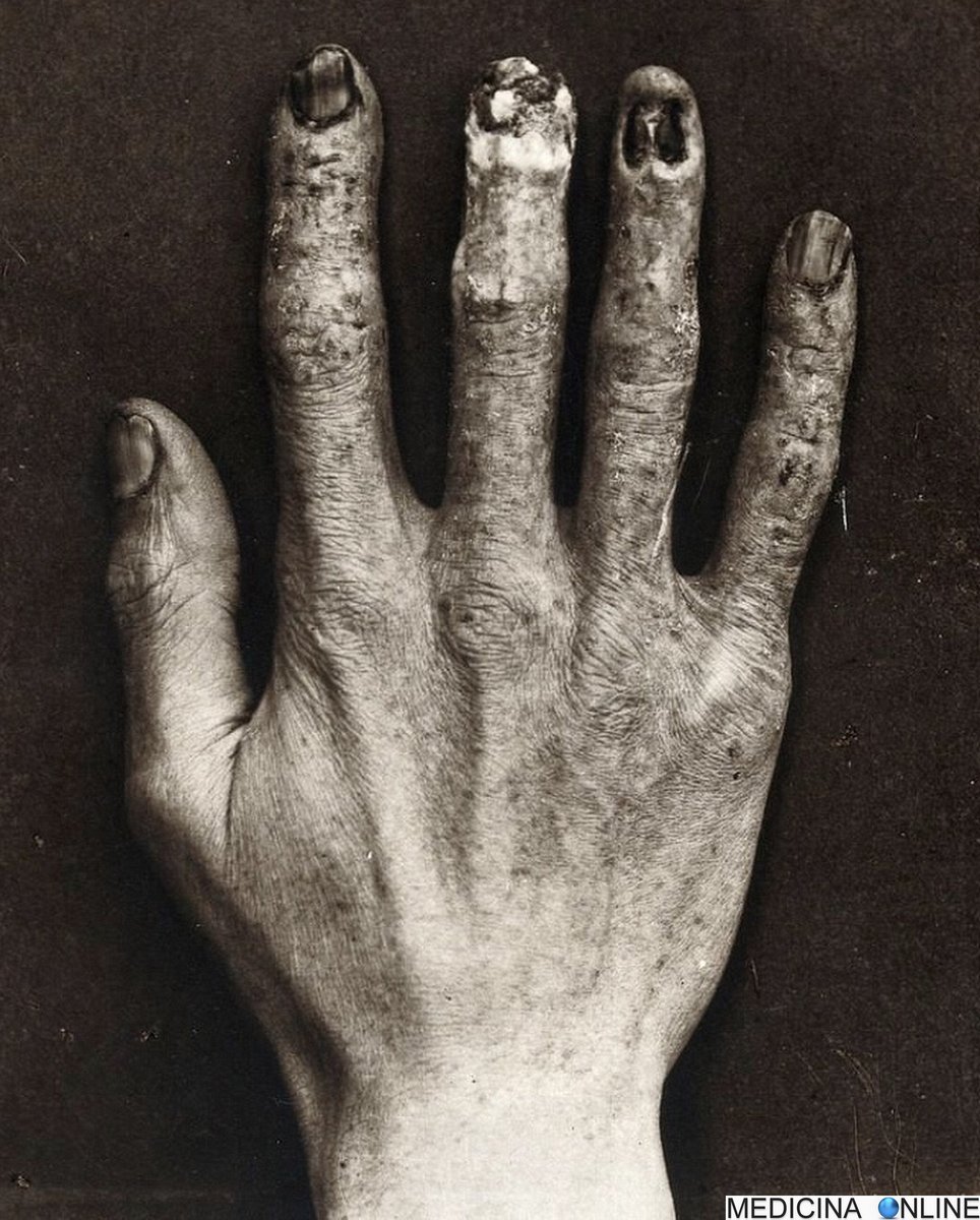 MedicinaOL's tweet photo. La mano ritratta in  questa immagine apparteneva a Clarence Madison Dally, riconosciuto come  la prima vittima documentata da esposizione cronica alle radiazioni  ionizzanti. https://t.co/578hAwNFUI