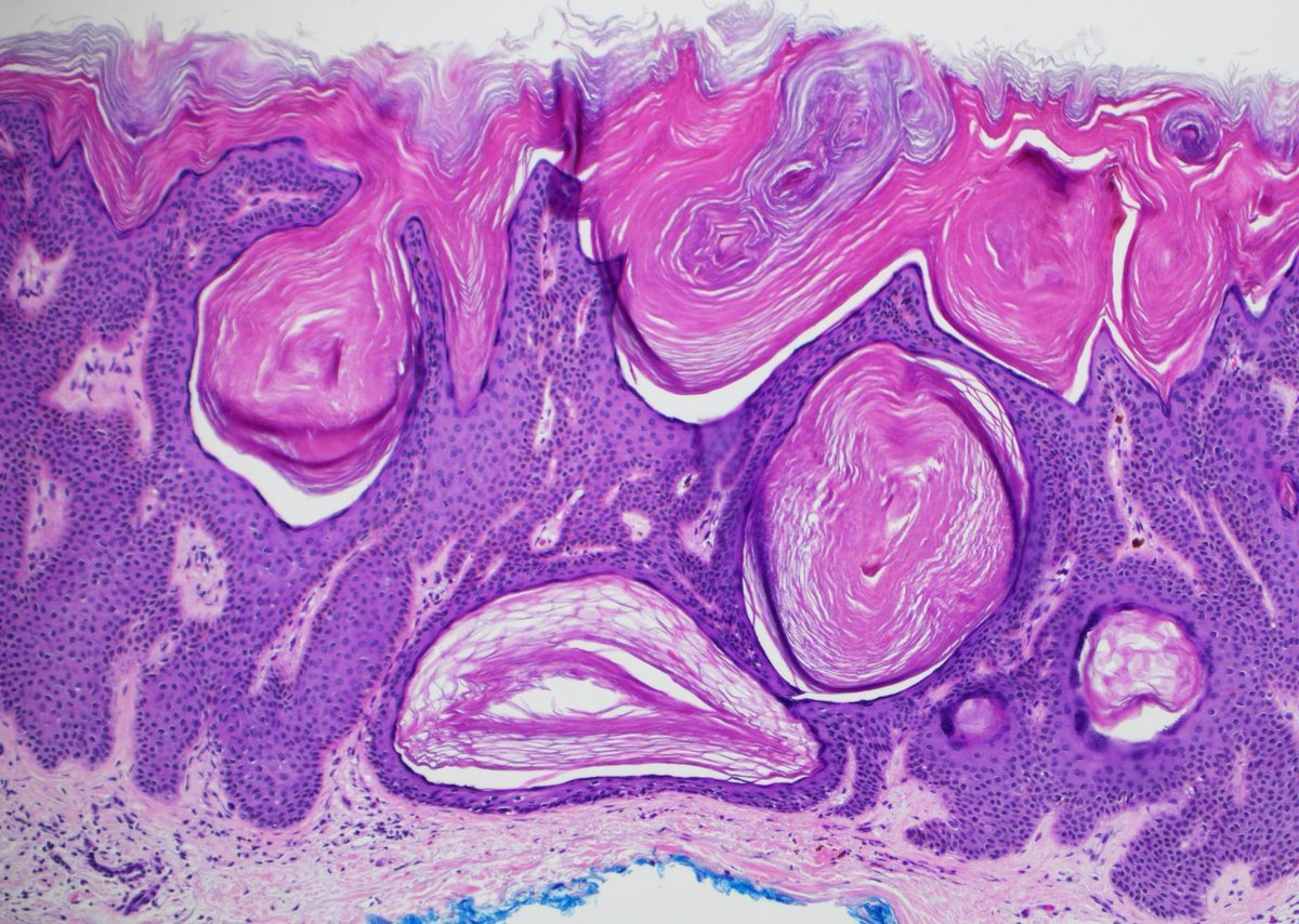 That feeling when you took on more projects than  you have time for and all the deadlines are past due… 😱😅
Diagnosis? Answer ✅ youtu.be/248j6YXOy6o
#pathology #pathologists #pathTwitter #dermpath #dermatology #dermatologia #dermtwitter