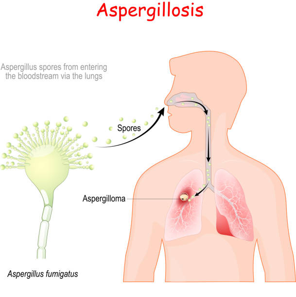Deadly Fungus Aspergillus fumigatus Spreading in US ‘Can Rot Human Tissue from Within’: Aspergillosis Symptoms and More

#aspergillosis #humantissues