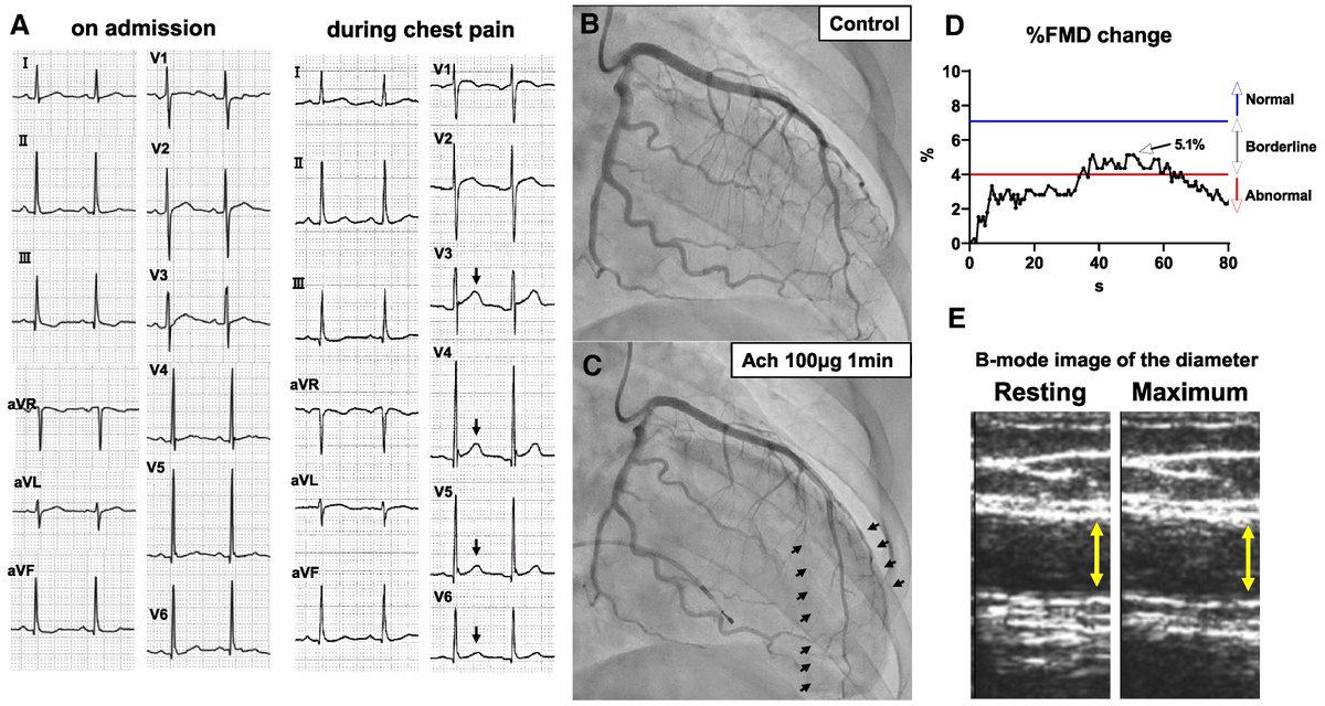 European Society of Cardiology Journals (@esc_journals) on Twitter photo Vasospastic angina in a young female-to-male transsexual. ow.ly/SY5Z50W5iFb
#EHJCaseReports <a href="/Phiso_de/">Philipp Sommer</a> <a href="/TJ_Yeo/">Tee Joo YEO</a> <a href="/aayshacader/">Aaysha Cader</a> <a href="/BoldiKovacsMD/">Boldizsar Kovacs</a> <a href="/KardiologieHH/">Erik Rafflenbeul</a> <a href="/ANazmiCalik/">A.Nazmi Calik</a> <a href="/O_Azizy_MD/">Obayda Azizy</a> <a href="/saramoscatelli7/">Sara Moscatelli</a> <a href="/EHJCREiC/">EHJCaseReports Editor-in-Chief</a> #CardioX #EPeeps Vasospastic angina in a young female-to-male transsexual. ow.ly/SY5Z50W5iFb
#EHJCaseReports <a href="/Phiso_de/">Philipp Sommer</a> <a href="/TJ_Yeo/">Tee Joo YEO</a> <a href="/aayshacader/">Aaysha Cader</a> <a href="/BoldiKovacsMD/">Boldizsar Kovacs</a> <a href="/KardiologieHH/">Erik Rafflenbeul</a> <a href="/ANazmiCalik/">A.Nazmi Calik</a> <a href="/O_Azizy_MD/">Obayda Azizy</a> <a href="/saramoscatelli7/">Sara Moscatelli</a> <a href="/EHJCREiC/">EHJCaseReports Editor-in-Chief</a> #CardioX #EPeeps