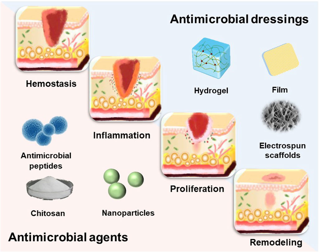 Did you know? Silver dressings can reduce the infection risk in wounds. I've just finished a research study on the subject, there's lots of great research out there! doi.org/10.1111/iwj.12…