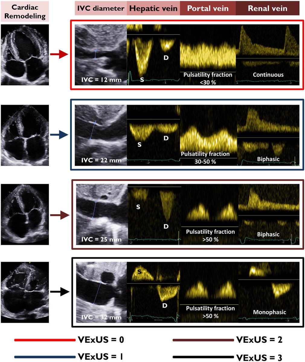 #POCUS #Nephpearls 
Among patients admitted for acute HF, #VExUS grade 3 was associated with in-hospital mortality (odds ratio, 8.03). The addition of VExUS score on top of the Get with the Guidelines (GWTG-HF) score improved the predictability of the model for in-hospital