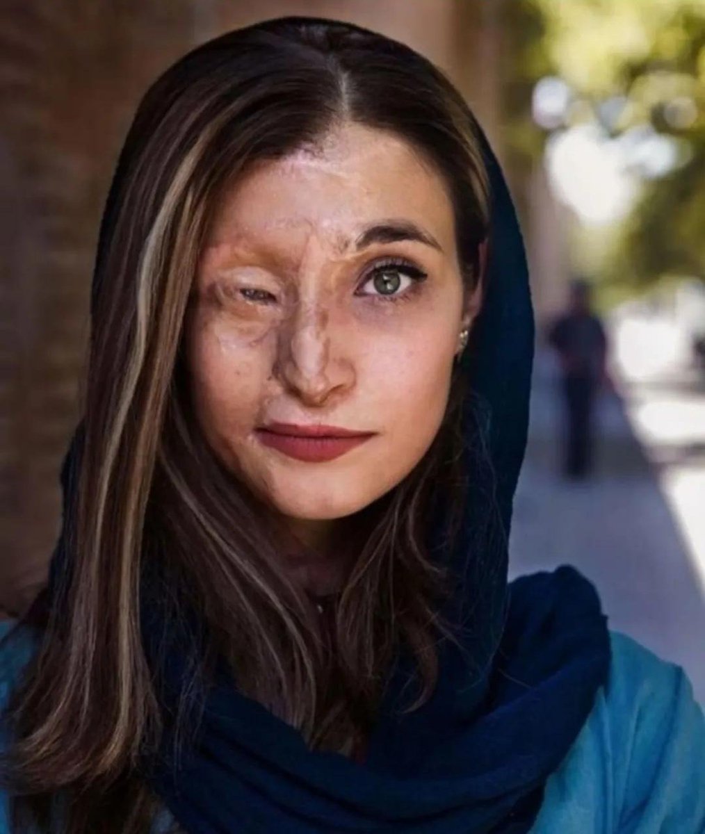 J’admire profondément le courage, même venu de vies très éloignées de la mienne.

En 2014, Marzieh Ebrahimi a survécu à une attaque à l’acide en Iran, pour un hijab jugé "inapproprié". 25 femmes ont été visées, une est morte, plusieurs ont perdu la vue.

Marzieh, elle, a choisi