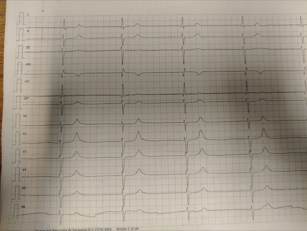 Dr. tocino (@marioalrb84_a) on Twitter photo Asymptomatic
BP ok
Rhythm?
<a href="/The_Nanashi_O/">Nanashī🫀</a> <a href="/JL_MoralesArt/">José Luis Morales</a> <a href="/Ecgloverr/">Pedram</a> <a href="/ecgandrhythmRoe/">Dr. Andreas Roeschl</a> <a href="/ecgrhythms/">Arnel Carmona</a> <a href="/EkgHacks/">ECG.Hacks</a> Asymptomatic
BP ok
Rhythm?
<a href="/The_Nanashi_O/">Nanashī🫀</a> <a href="/JL_MoralesArt/">José Luis Morales</a> <a href="/Ecgloverr/">Pedram</a> <a href="/ecgandrhythmRoe/">Dr. Andreas Roeschl</a> <a href="/ecgrhythms/">Arnel Carmona</a> <a href="/EkgHacks/">ECG.Hacks</a>