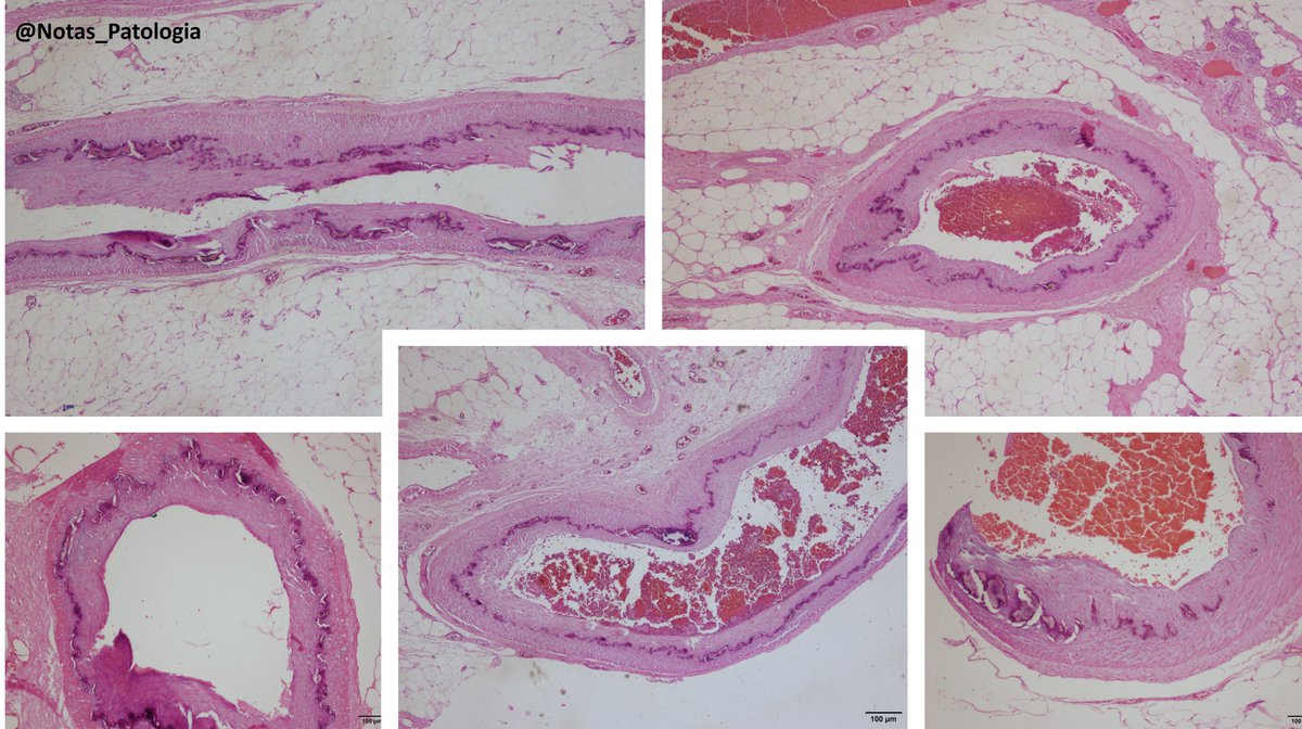 🧠 Mönckeberg’s Arteriosclerosis: the forgotten calcification

🕰️ A bit of history:
Mönckeberg’s arteriosclerosis was first described in 1903 by German pathologist Johann Georg Mönckeberg, who identified calcium deposits in the medial layer of arteries without associated