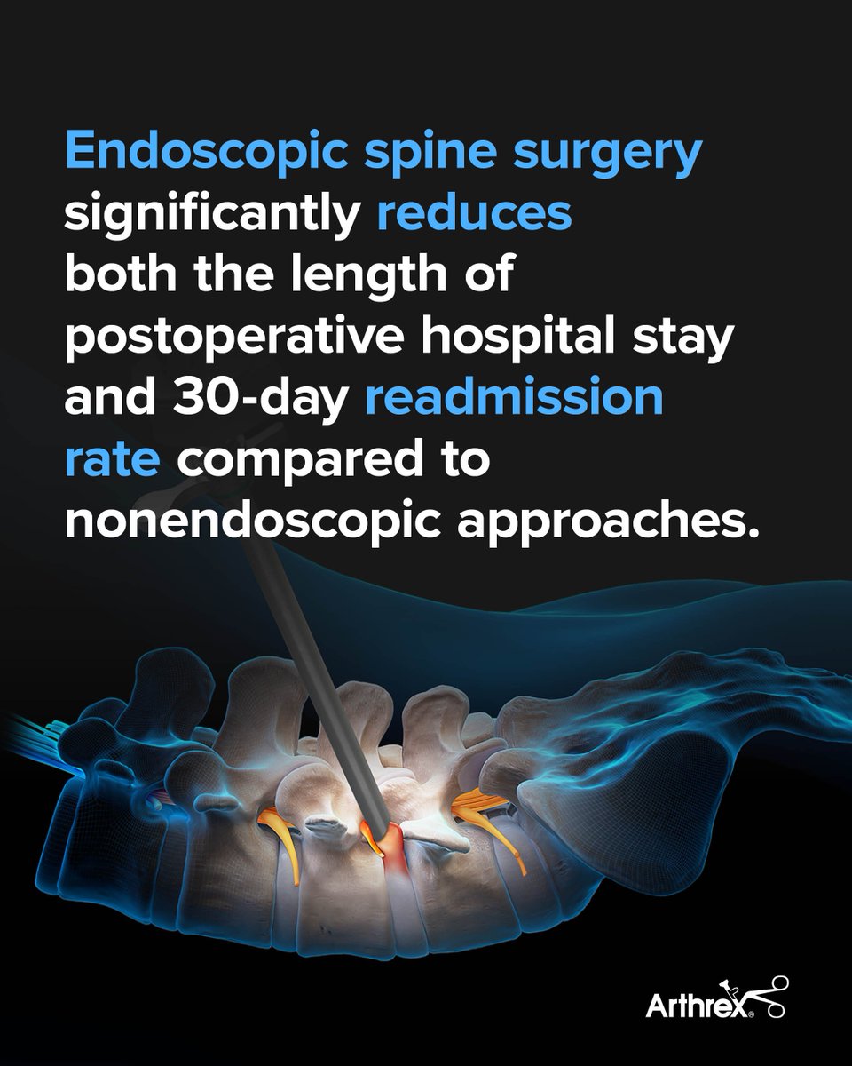 ArthrexSpine's tweet image. “Endoscopic spine surgery demonstrates a shorter hospital stay, reduced 30-day readmissions, fewer infections—it’s not magic, it’s just better,” said Arthrex faculty surgeon Mark Mahan, MD.
This study is the first to compare 30-day hospital readmissions between full-endoscopic…
