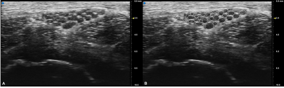 Journal of Clinical Neurophysiology (@jclinneurophys) on Twitter photo Meiling, Caress, and Cartwright used ultra-high frequency ultrasound to study the median nerve in patients with #ALS.  Compared to previous controls, there was no difference in the number of fascicles in the median nerve.  @wakeneurores 💪 <a href="/ACNS_org/">ACNS</a> ow.ly/OPU050W8onq Meiling, Caress, and Cartwright used ultra-high frequency ultrasound to study the median nerve in patients with #ALS.  Compared to previous controls, there was no difference in the number of fascicles in the median nerve.  @wakeneurores 💪 <a href="/ACNS_org/">ACNS</a> ow.ly/OPU050W8onq