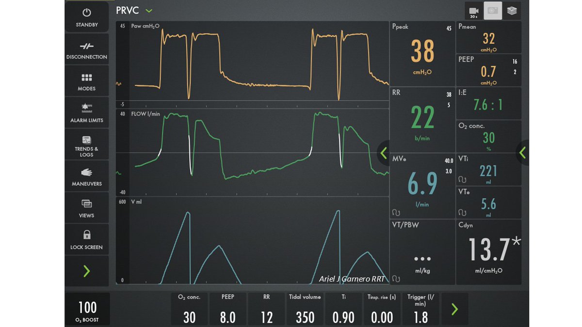 What is going on? How would you improve it? <a href="/DocMusician/">Doc Musician</a> <a href="/DrMiguelIbarra1/">Dr. Miguel Ibarra-Estrada</a> <a href="/emireles_c/">Eduardo Mireles-Cabodevila</a> <a href="/CCF_PCCM/">CCF Pulmonary and Critical Care Fellows</a> <a href="/critconcepts/">Critical Concepts</a> <a href="/IM_Crit_/">IMCrit</a> <a href="/Vent_Busters/">VentBusters</a> <a href="/OfVentilation/">Society of Mechanical Ventilation</a> <a href="/SaudiRTs/">Saudi Respiratory</a> <a href="/GkuhnRRT/">Gary Kuhn</a> <a href="/RespiratorySCCM/">SCCM Respiratory Care Section</a> <a href="/MegriMohammed/">Mohammed Megri. MD</a>