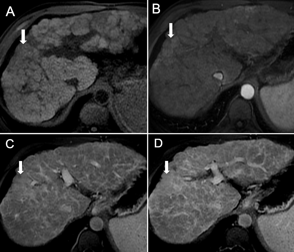 MedBlendPub's tweet image. 🧠 #Case_of_the_Day
💡Confluent Hepatic Fibrosis: a benign pseudolesion
#Imaging_Clues ⬇️
🔹 T1 hypointense
🔹 T2 mildly hyperintense
🔹 Delayed enhancement
🔹 Capsular retraction: A hallmark feature 🎯
🔹 Mostly in posterior liver segments
#Radiology #MRI #Cirrhosis #RadRes